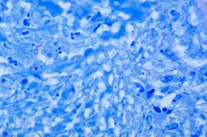 Mycobacterium_tuberculosis_Ziehl-Neelsen_stain