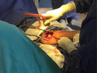 Surgery to correct the misalignment of a two-year-old girl's femur. Photo credit - Hannah Krystal
