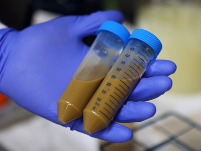 Fecal Microbiota Transplantation: The Future of&nbsp;Feces